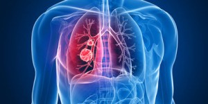 How to Treat Bronchiectasis