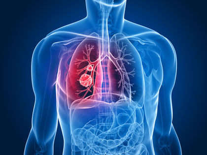 How to Treat Bronchiectasis