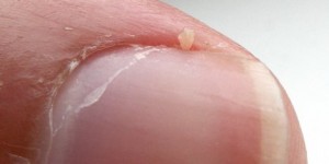 How to Remove Hangnails
