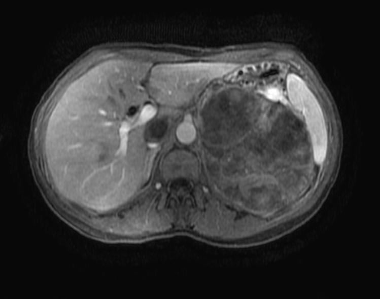 Adrenal Cortical Carcinoma