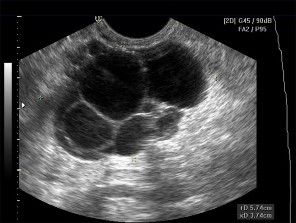 Ovarian Cysts