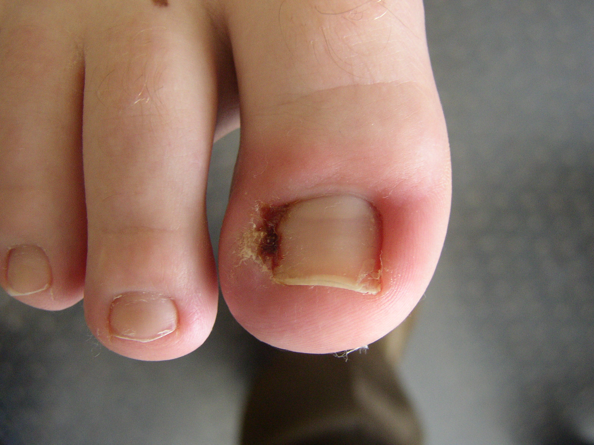 Ingrown toenails