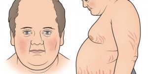 Complications and Treatments of Cushing Syndrome