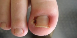 All You Need to Know About Ingrown Toenails