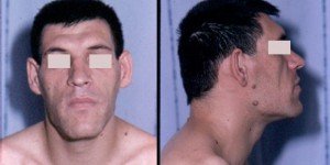 Causes, Symptoms and Treatments of Acromegaly