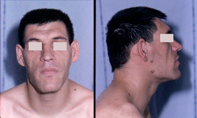 Acromegaly before and after