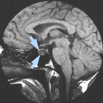 pituitary cancer